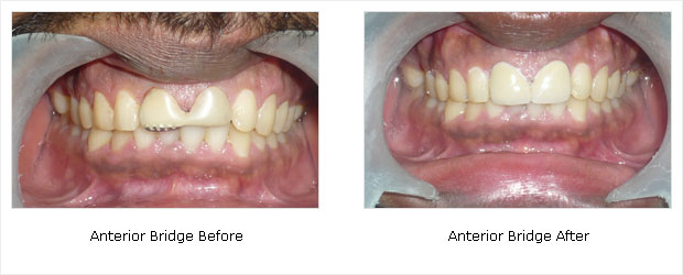 Anterior Bridge