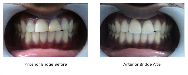 Anterior Bridge