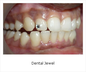 Dental jewel